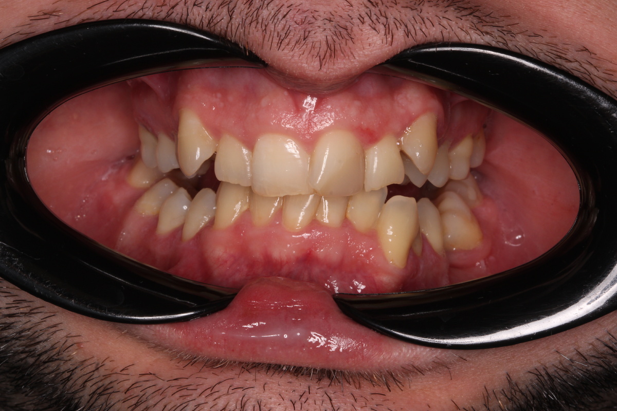 Скученность зубов: как добиться идеальной гигиены и избавиться от налета